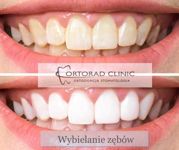 Wybielanie zębów